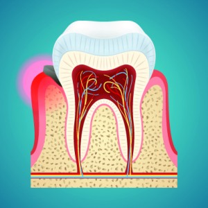 Gingivitiss