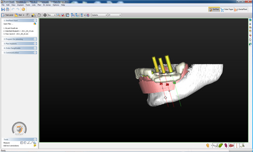 Cone-Beam Guided Implant Surgery