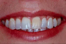 After cosmetic periodontal procedure