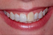 Before cosmetic periodontal procedure