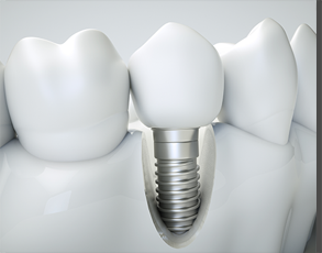 Dental implant illustration