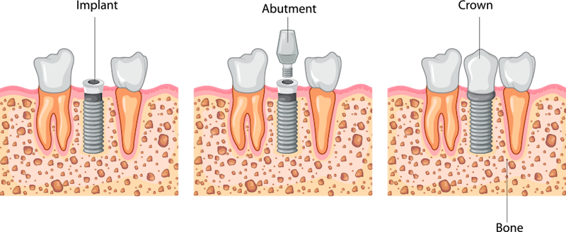 Dental implants