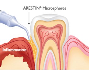 Arestin application diagram