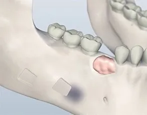 Bone grafting illustration