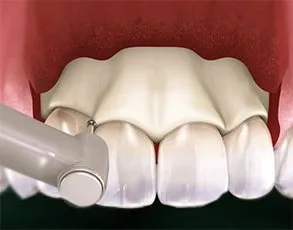 Crown lengthening