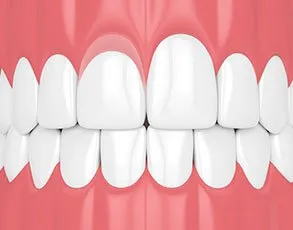 Gingivectomy