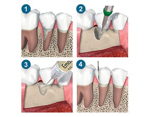 Guided bone tissue regeration