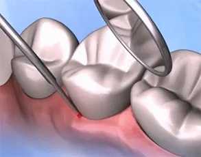 Illustration showing gum disease laser therapy with dental laser instruments treating inflamed gum tissue around teeth