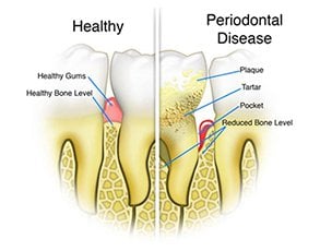 periodontal disease