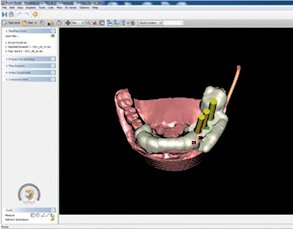 Simplant CT Software