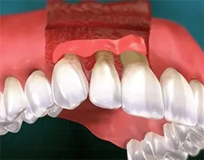 Soft tissue graft