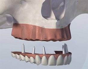 Teeth-in-an-Hour