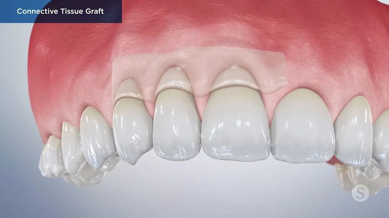 Connective Tissue Graft Video Thumbnail