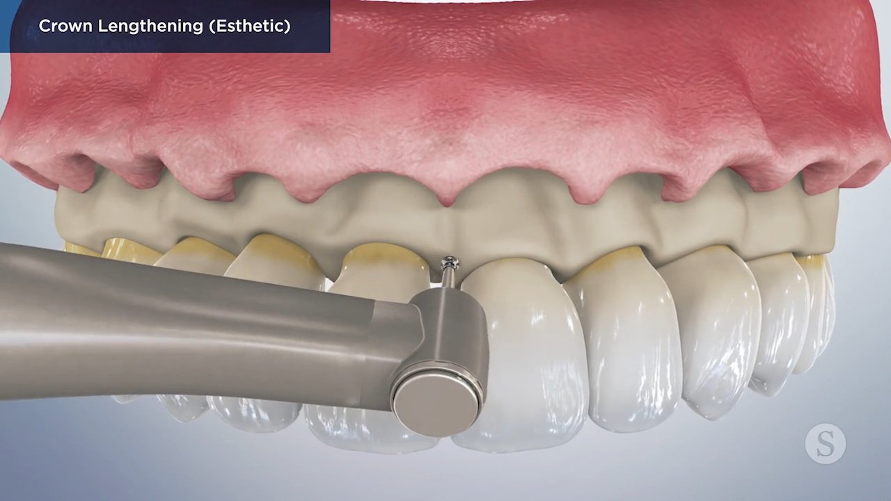 Crown Lengthening Esthetic Video Thumbnail