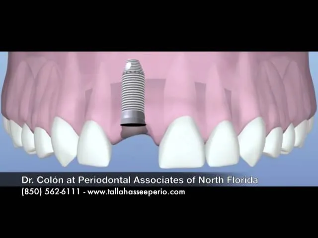 Dental Implants by Dr Colon at Periodontal Associates of North Florida 3 Video Thumbnail