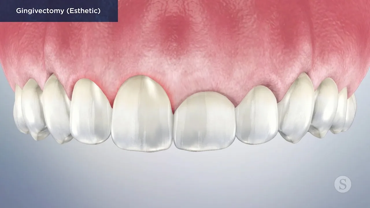 Gingivectomy Esthetic Video Thumbnail