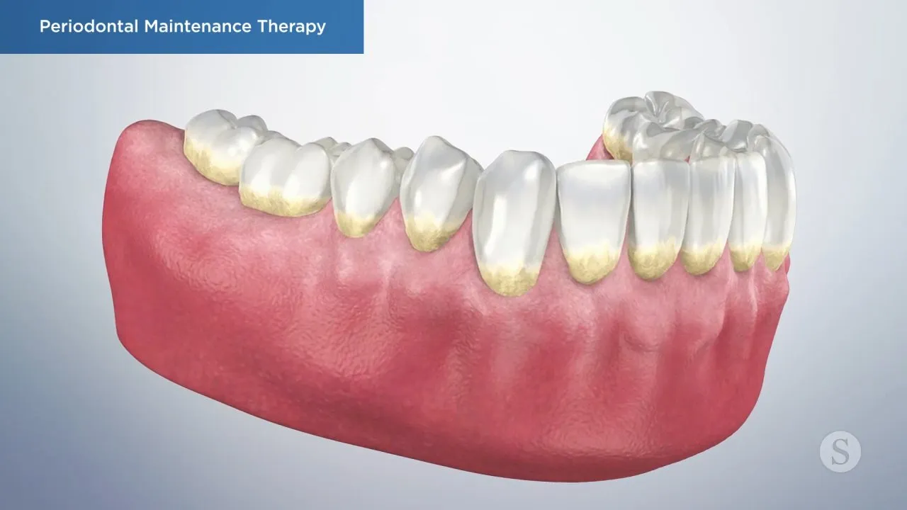 Periodontal Maintenance Therapy Video Thumbnail