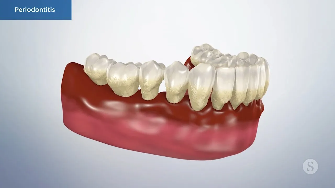 Periodontitis Video Thumbnail