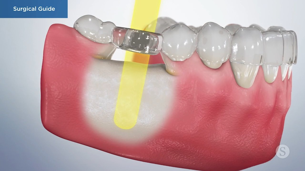 Surgical Guide Video Thumbnail